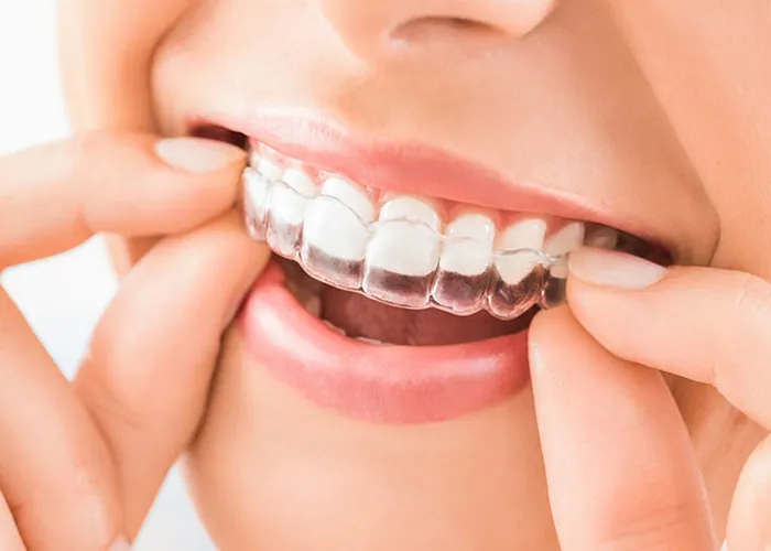 Invisalign Braces