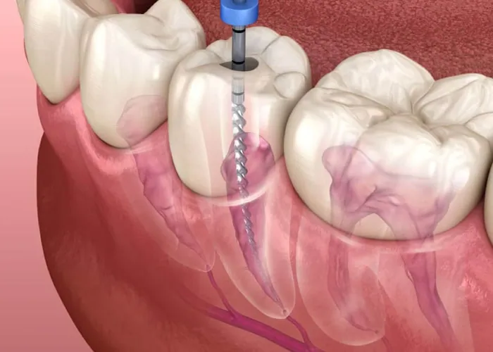 Root Canal Treatment